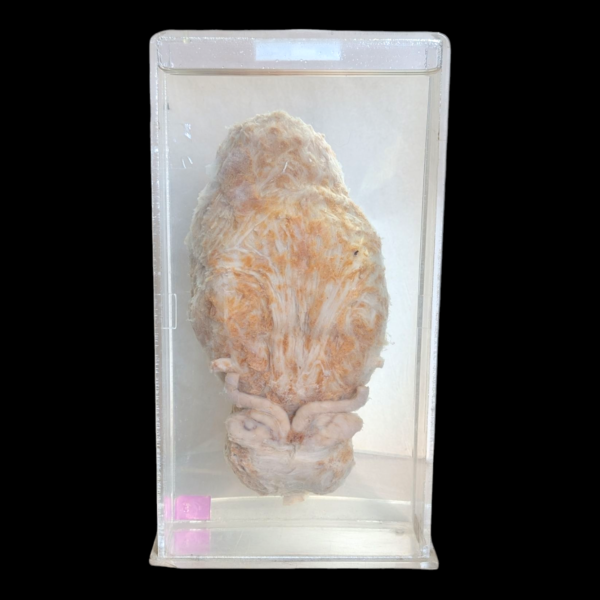 Human Bladder With Tumors Wet Specimen - Image 3