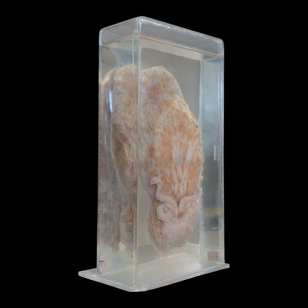 Human Bladder With Tumors Wet Specimen