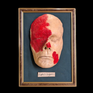 Framed Wax Medical Teaching Mask – Lupus Vulgaris