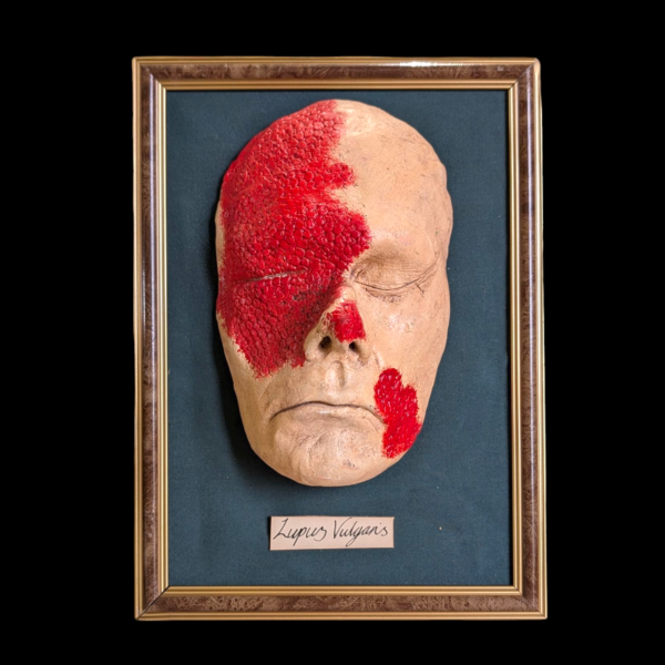 Framed Wax Medical Teaching Mask – Lupus Vulgaris