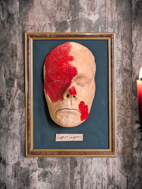 Framed Wax Medical Teaching Mask – Lupus Vulgaris - Image 2
