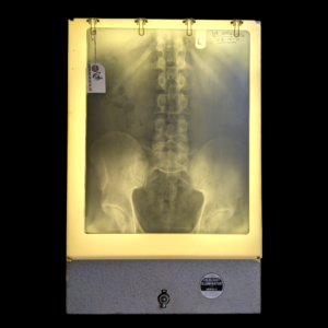 Vintage Medical Coldlight X-Ray Illuminator with Spinal X-Ray – 1971 Radiography Display