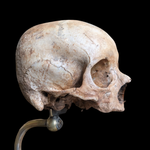 Rare Deformed Real Human Skull on Ornate Brass Anatomical Stand - Image 5