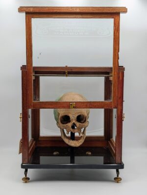 Authentic Human Medical Skull in Period Glazed Display Case