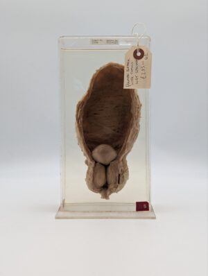 Medical Human Bladder with Tumours – Preserved Wet Specimen Teaching Sample