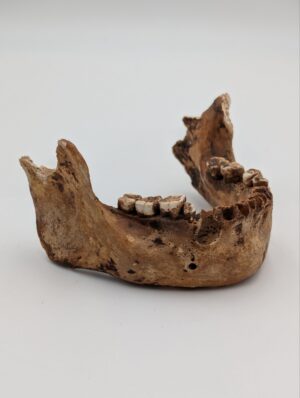 Authentic Human Mandible – Ex Medical Anatomical Specimen